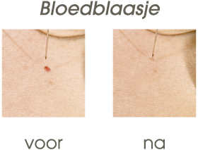 bloedblaasje