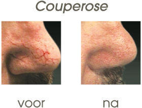 couperose