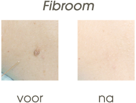 fibroom